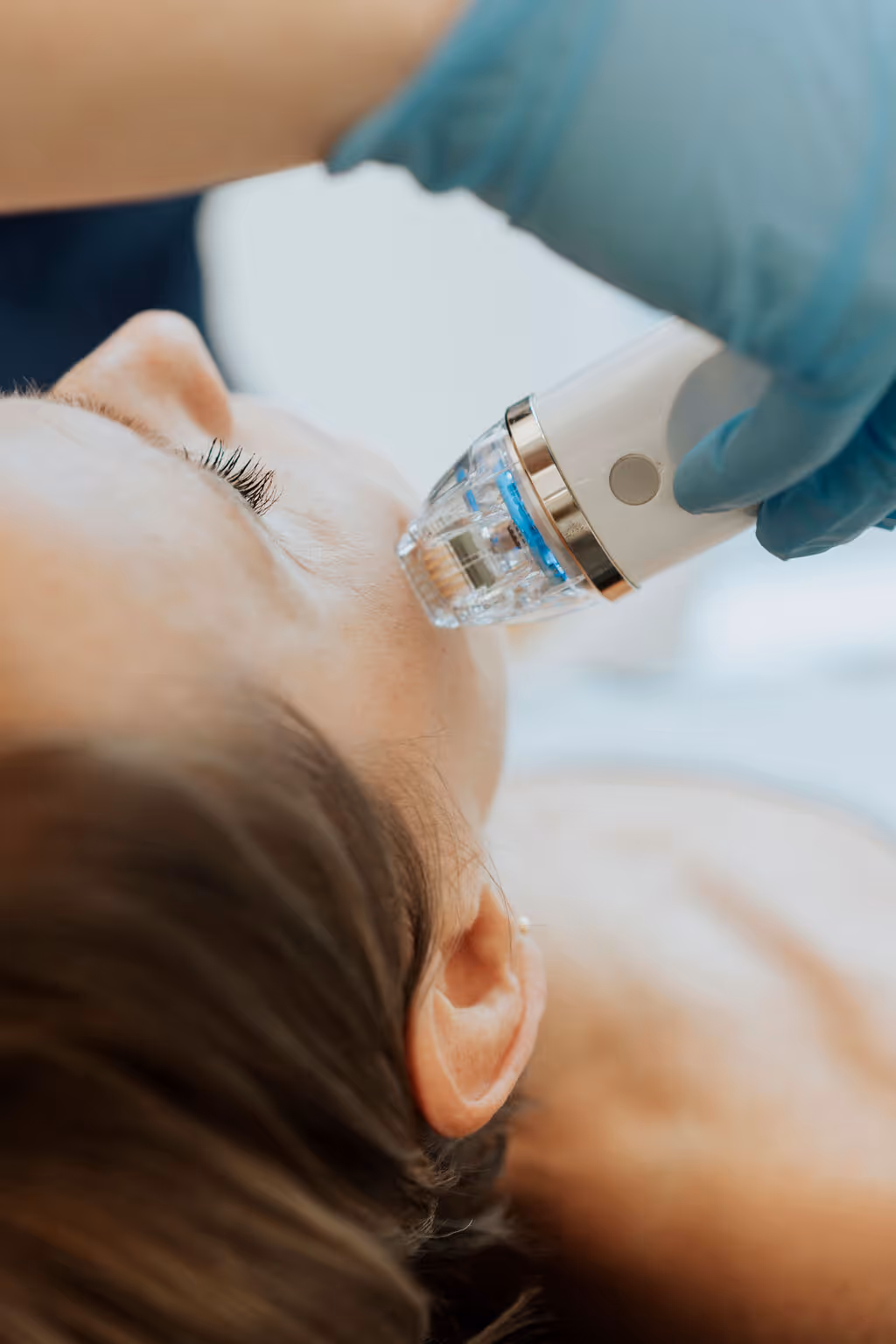 Mircroneedling Radio Frequenz. Marpheus/ RF Secrets