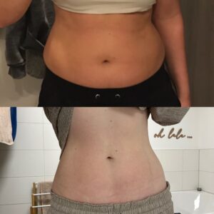 Vorher Nachher Abnehmen Behandlung im Aesthetica Naturheilzentrum Ulm