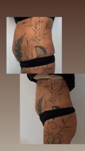 Vorher Nachher Bauchstraffung Behandlung Aesthetica Naturheilzentrum Ulm