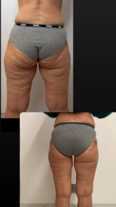 Vorher Nachher Bodyforming Beine Behandlung Aesthetica Naturheilzentrum Ulm