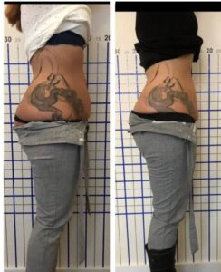 Vorher Nachher Bodyforming Behandlung im Aesthetica Naturheilzentrum Ulm