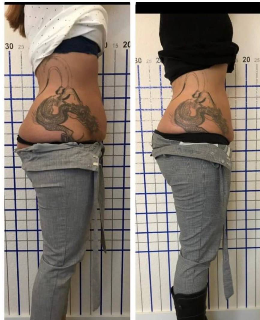 Vorher Nachher Bodyforming Behandlung im Aesthetica Naturheilzentrum Ulm