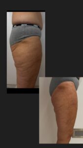 Vorher Nachher Fettverlust Körper Behandlung Aesthetica Naturheilzentrum Ulm