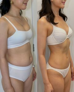 Vorher Nachher Körperformung Behandlung Aesthetica Naturheilzentrum Ulm