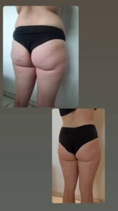 Vorher Nachher Physiq360 Behandlung Aesthetica Naturheilzentrum Ulm