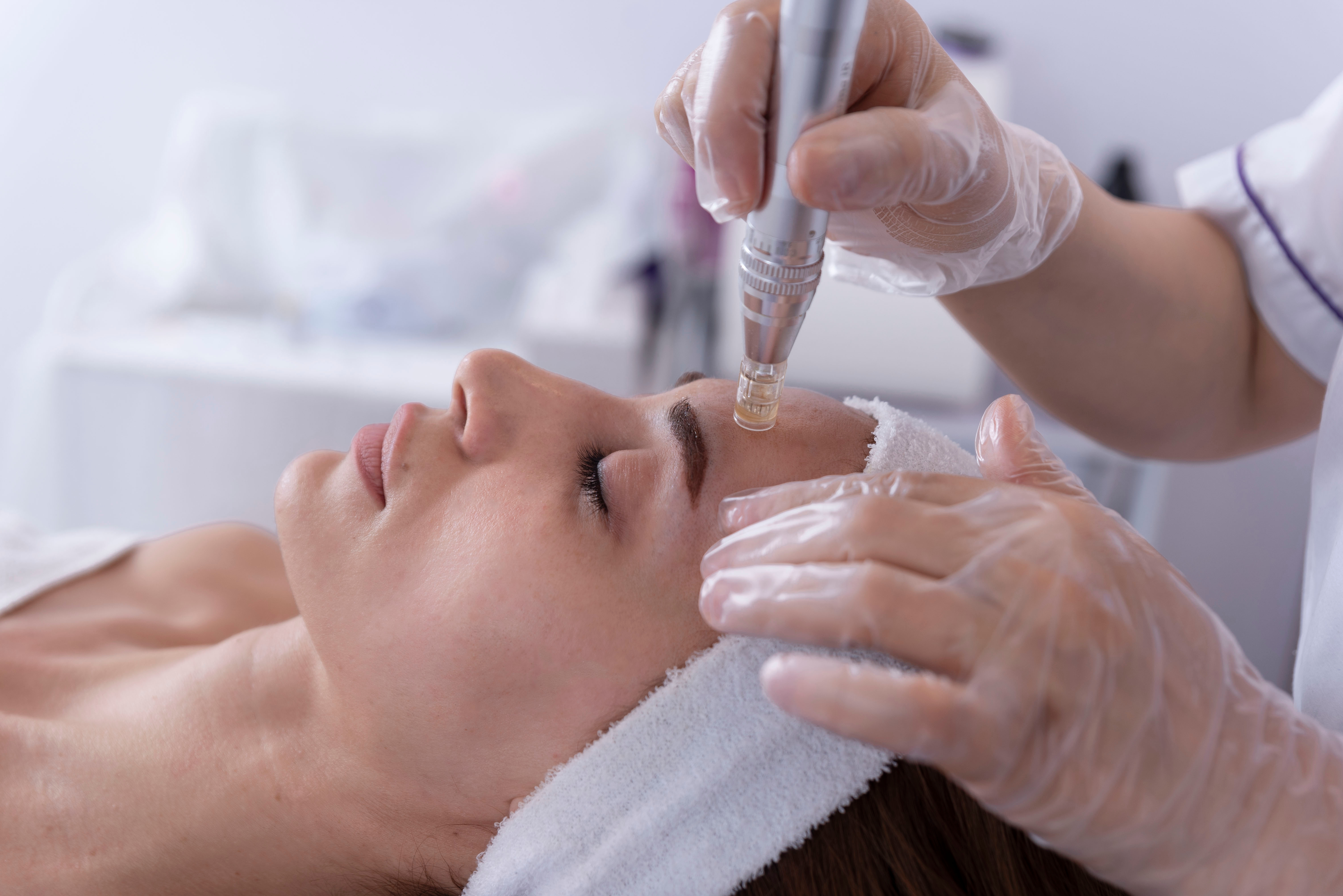 Microneedling Ulm