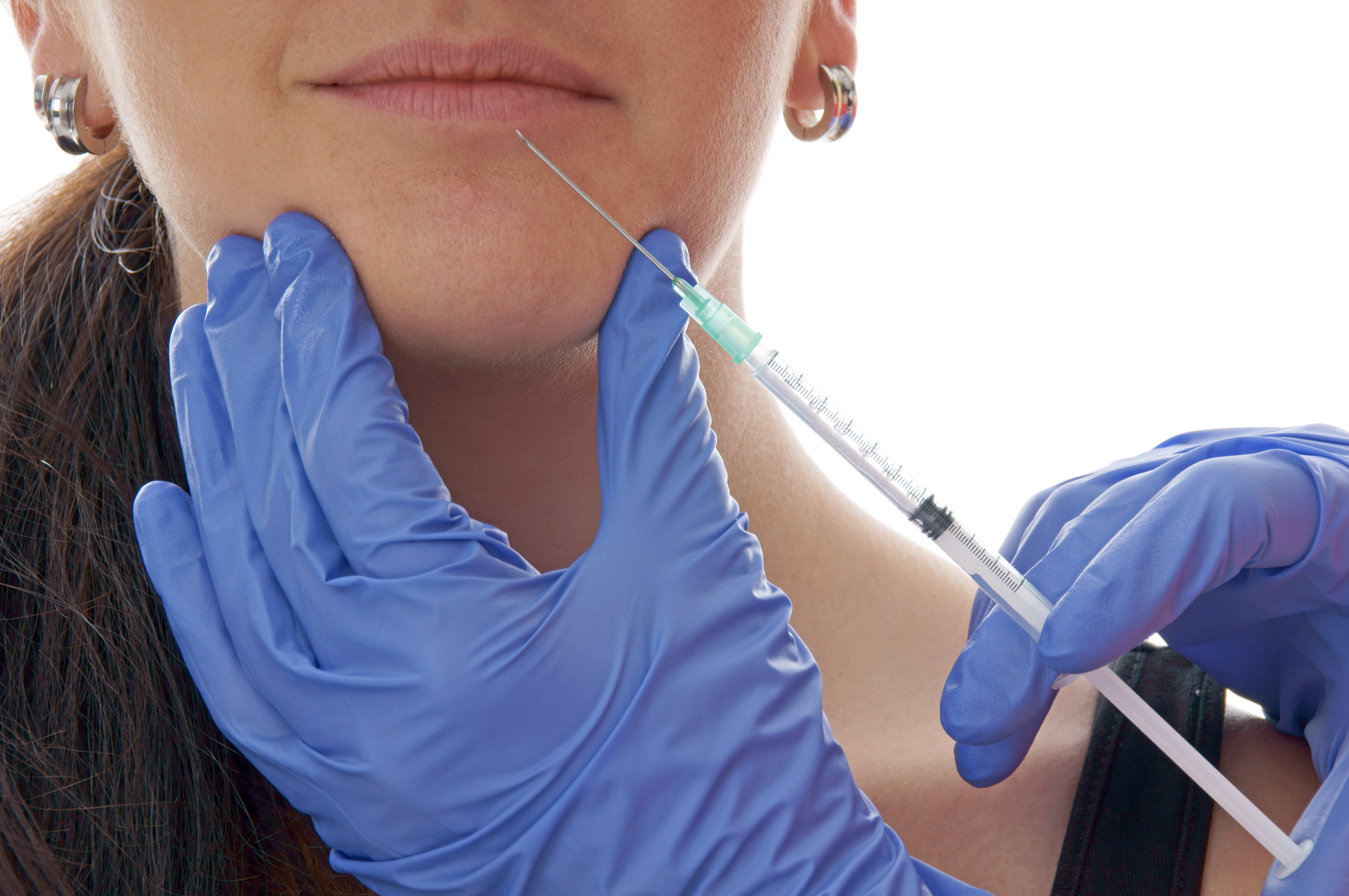 Lippen aufspritzen in der Nähe - natürliches optimieren der Lippenform